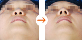 鼻整形をもっと身近に メスを使わない鼻整形クレオパトラノーズ シンシアガーデンクリニック