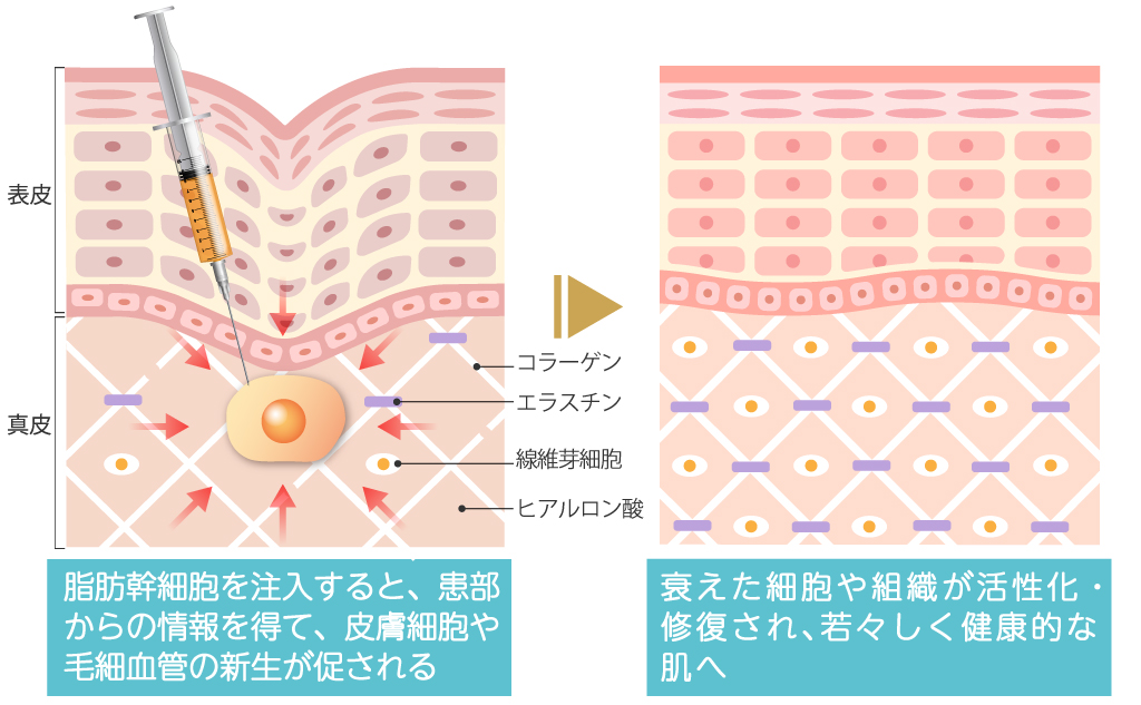 自己脂肪幹細胞治療の作用機序