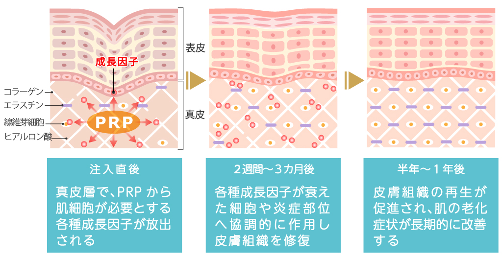 PRP皮膚再生療法の作用機序