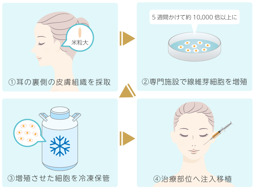 真皮線維芽細胞療法の施術の流れ