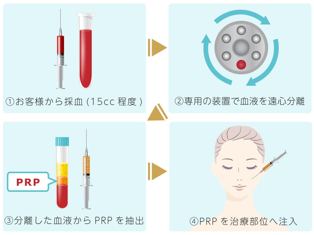 PRP皮膚再生療法の流れ