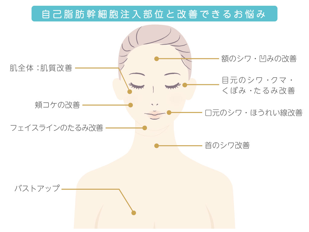 自己脂肪幹細胞注入部位と改善できるお悩み
