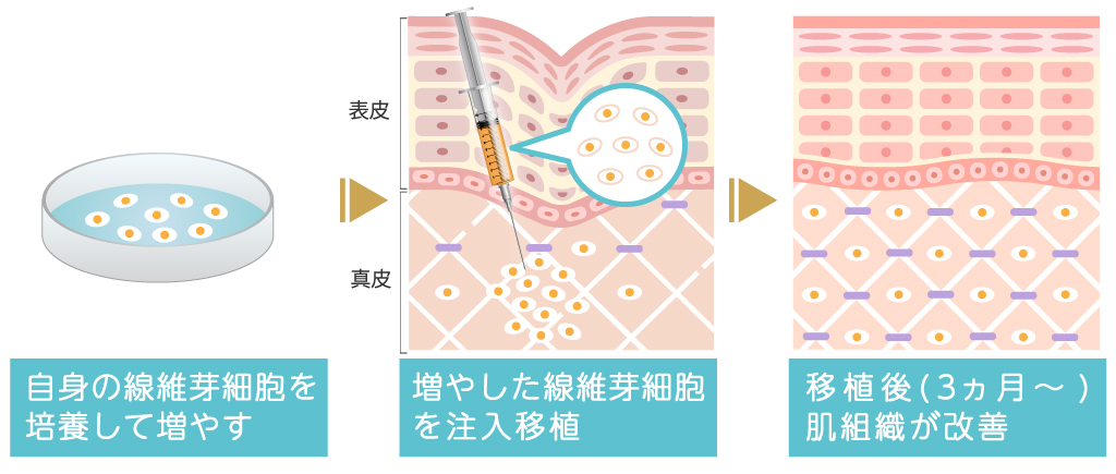 真皮線維芽細胞療法の作用機序