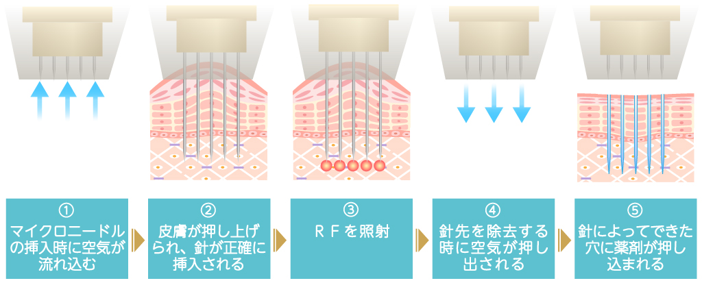 ドラッグデリバリー(薬剤導入)による相乗効果