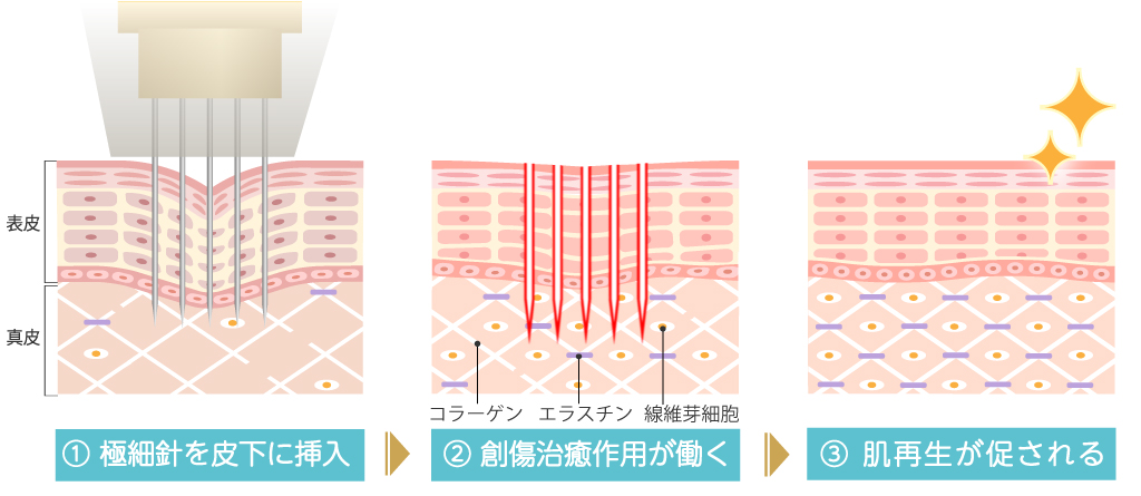 創傷治癒力を利用した肌再生作用