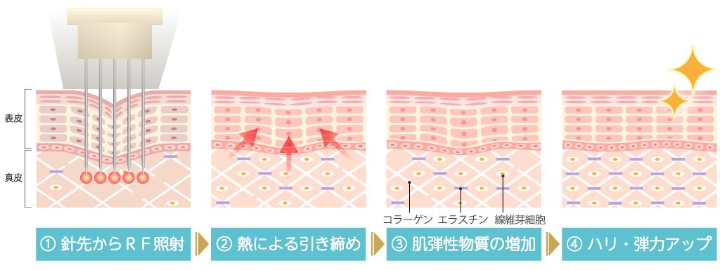 ニードルRFによる引き締め作用